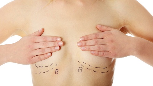 Nâng ngực không cần phẫu thuật bằng mỡ tự thân