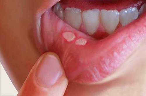 Nguyên nhân nào dẫn đến bệnh nhiệt miệng?