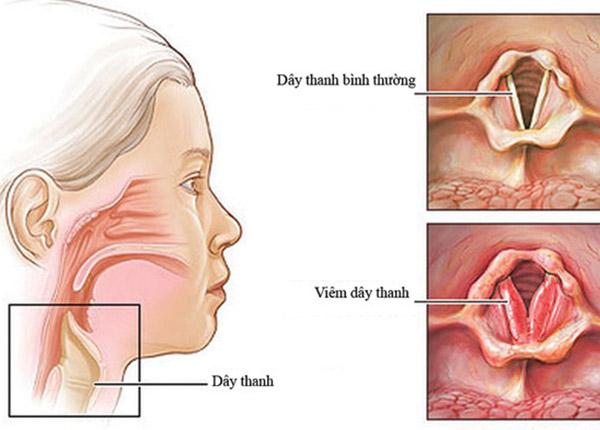 Bệnh viêm thanh quản là tình trạng dây thanh âm bị sưng dẫn đến khản hoặc mất giọng