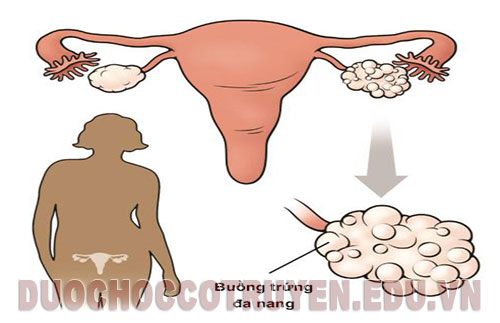 Dược học cổ truyền trị chứng vô sinh do đa nang buồng trứng