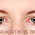 Bài thuốc Đông Y chữa đau mắt đỏ đơn giản, hiệu quả