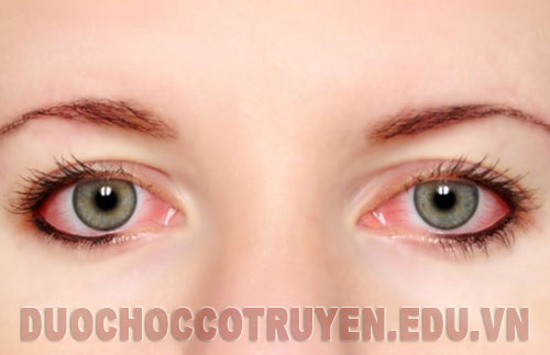 Bài thuốc Đông Y chữa đau mắt đỏ đơn giản, hiệu quả