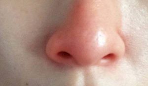 Bài thuốc Y học cổ truyền tân lục phương phương trị bệnh mũi đỏ