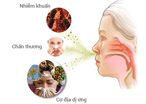 Viêm mũi dị ứng là căn bệnh dễ mắc phải ở nhiều lứa tuổi